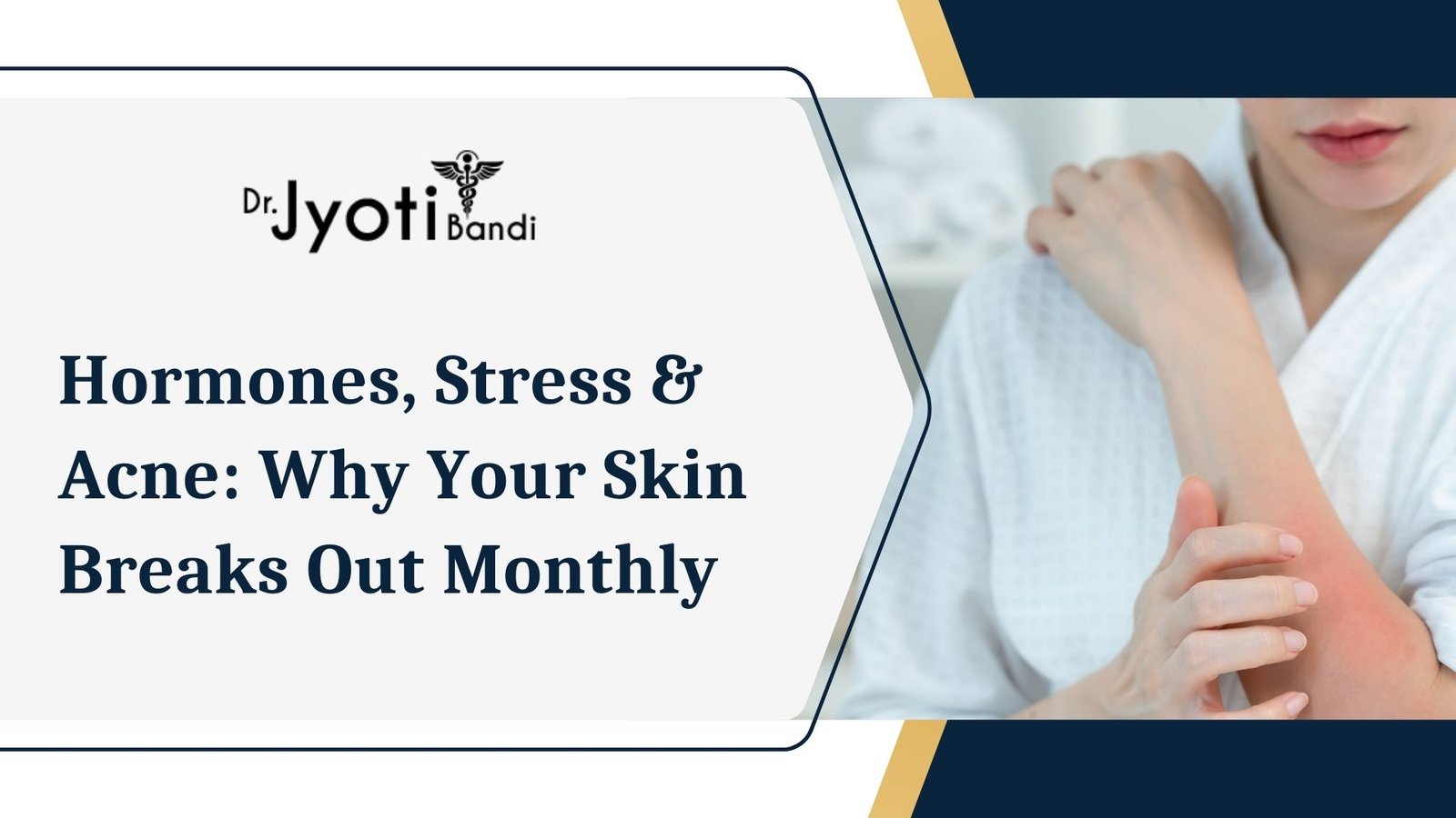 Hormones, Stress & Acne: Why Your Skin Breaks Out Monthly